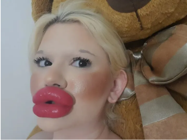 Девушка 27 раз колола филлеры, чтобы увеличить губы и стать красивой